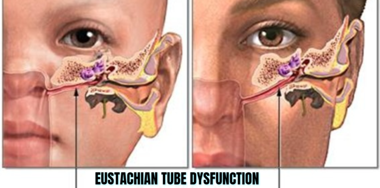 Eustachian Tube Dysfunction